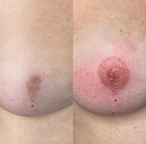 Reconstrucción de Areolas Mamarias - Servicio Profesional